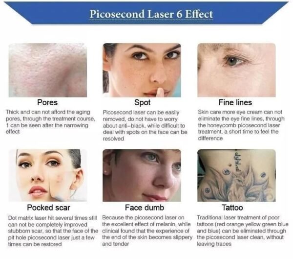 Portable Pico Laser Machine For Tattoo Removal, Carbon Facial Eyebrows, Skin Cleaning, Oil Control, Pigmentation treatment and Freckle Removal - Image 6